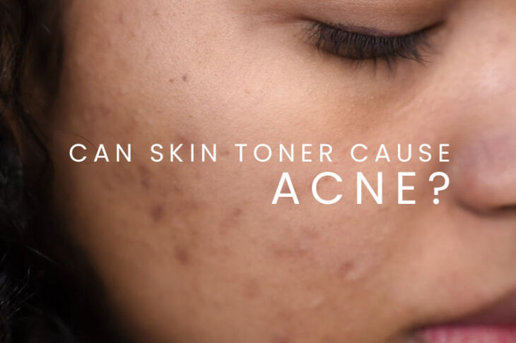 How To Use Toner For Acne