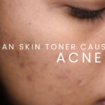 How To Use Toner For Acne