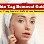 Skin Tag Removal Guide